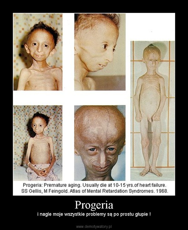 Progeria – i nagle moje wszystkie problemy są po prostu głupie ! 
