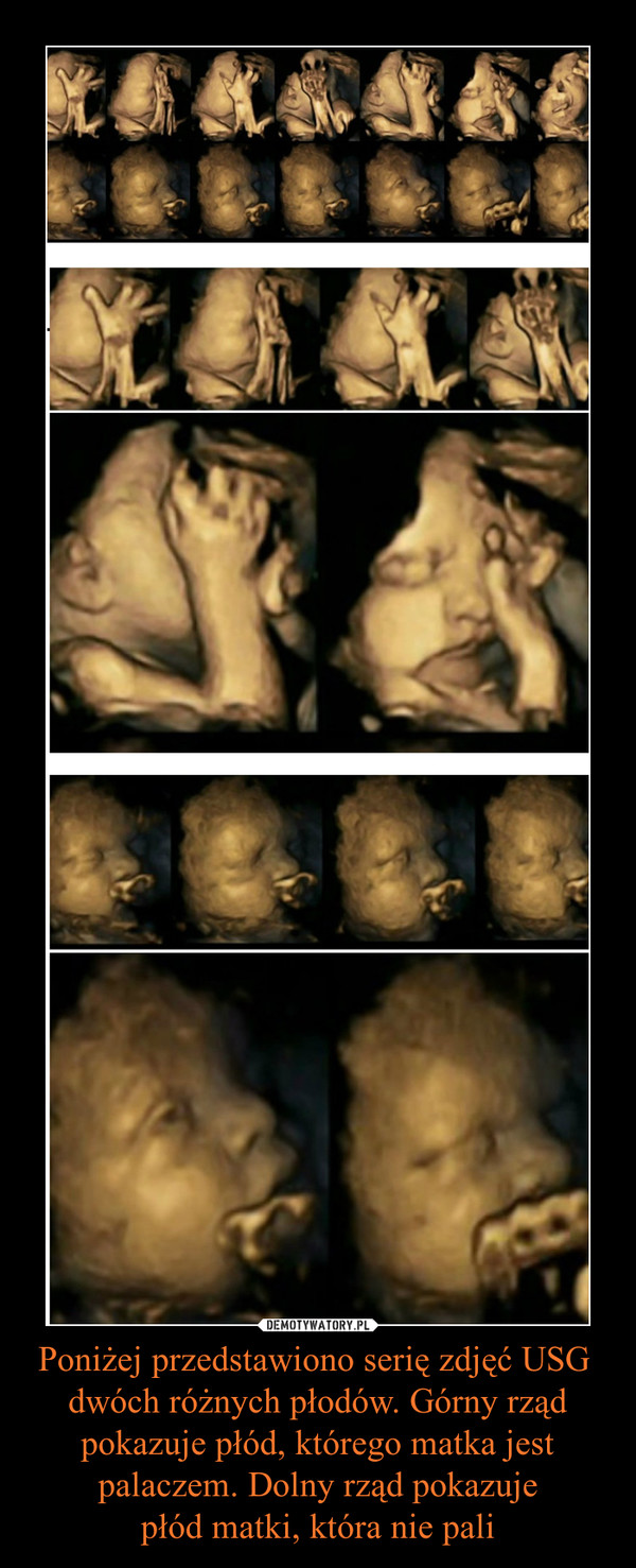 Poniżej przedstawiono serię zdjęć USG dwóch różnych płodów. Górny rząd pokazuje płód, którego matka jest palaczem. Dolny rząd pokazujepłód matki, która nie pali –  