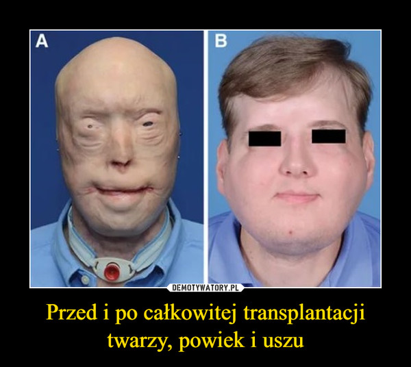 Przed i po całkowitej transplantacji twarzy, powiek i uszu –  